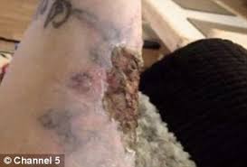 At shaddix plastic surgery, our entire team wants to help you reach your aesthetic goals. Mother Left With Agonising Chemical Burns After Using 25 Acid Peel Kit She Bought Online To Remove Tattoo Of Ex Partner S Name Daily Mail Online