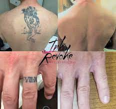 Tattoo removal available at the boulder and westminster locations. Affordable Prices Ink Revoke