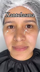 Image result for xantelasma