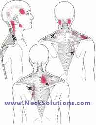 Both the deltoid and the trapezius are firmly attached to the spine of the scapula. Neck And Shoulder Pain Solutions For A Common Disorder