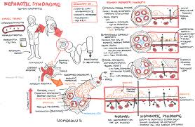 nephrotic syndrome armando hasudungan