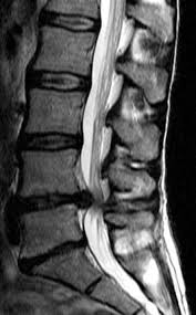 Image result for vyhřezlá ploténka