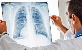 The cancer does not show up on imaging scans, but cancerous cells might appear in the phlegm or mucus. No Pain And Cough Symptoms Lung Cancer Patients Are Often Late For Treatment Okezone Lifestyle Netral News