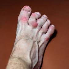 Image result for gout symptoms toe
