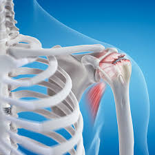 Image result for Rotator cuff tear