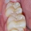 Wenn eine karies in der zweiten zahnschicht, dem dentin, ist, muss meistens gebohrt werden, da es sonst. Https Encrypted Tbn0 Gstatic Com Images Q Tbn And9gctsjhmqyxb3e4qvq1qerc5wavehij2zotf5xg4aankjw8ftappx Usqp Cau