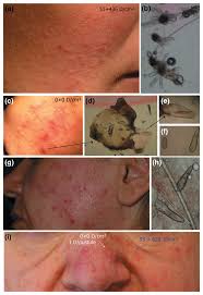 Image result for demodex rosacea