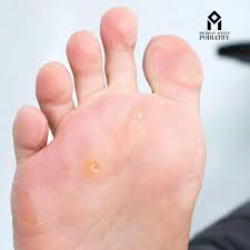 Image result for Corns