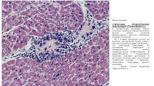 I периартерии́т узелко́вый (periarteriitis nodosa; Revmaticheskie Bolezni æ—©æ—©æ—©æ—© é¢¨é¢¨é¢¨é¢¨é¢¨ Zabolevaniya Soedinitelnoj