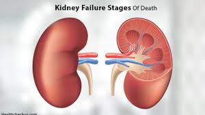 Chronic renal failure develops into end stage renal disease (esrd). What Are The Kidney Failure Stages Of Death Health Checkup