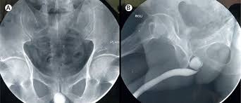 Image result for Retrograde Urethrogram