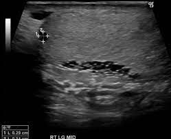 Most of the time it is discovered incidentally on scrotal sonograms and may be misinterpreted as malignant. Tubular Ectasia Of Rete Testis Radiology Reference Article Radiopaedia Org