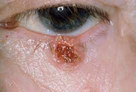 Skin cancer is one of the most common types of cancer. Image Basal Cell Carcinoma Of Eyelid Msd Manual Professional Edition
