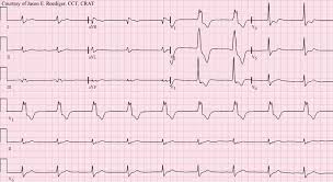 The av node usually only beats at 40 to 60 beats per minute, but in accelerated junctional rhythm the rate is faster than 60 beats per minute, but still slower than 100 beats per minute. Akzelerierter Idioventrikularer Rhythmus Wikipedia