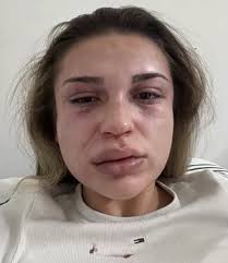 19-годишна жестоко пребита от гаджето си в Кресна. 21-годишният насилник  Богдан Димитров я отвлякъл на неоживено място, където ѝ е нанесъл множество  удари по цялото тяло. Момичето е открито в безпомощно състояние