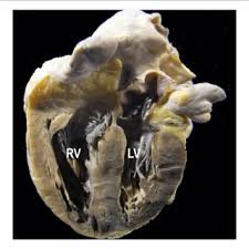 Image result for Cor Pulmonale