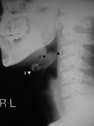 Image result for Hyoid Bone