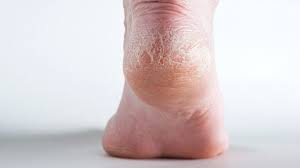 Is That Rash Psoriasis Psoriasis Pictures And More Everyday Health