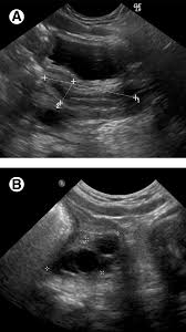 Find out why a doctor might order this type. Ultrasound Of The Pediatric Female Pelvis Sciencedirect