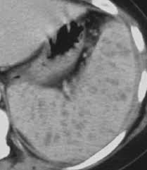 Image result for Splenic Abscess