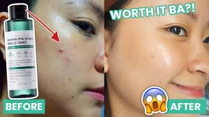 Beauty, cosmetic & personal care. Trending 30 Days Miracle Toner Some By Mi Review Giveaway Closed Youtube