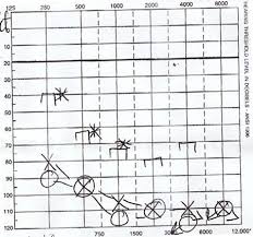 How To Interpret An Audiogram From A Hearing Test