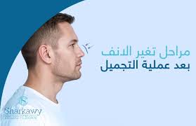 ما هي مراحل تغير الانف بعد عملية التجميل ؟ | د/ عمر الشرقاوي