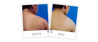 When you decide to remove your tattoo, laser tattoo removal works to break up pigment for permanent removal of the ink. Nd Yag Laser Tattoo Removal System Ry 280 Adss Laser