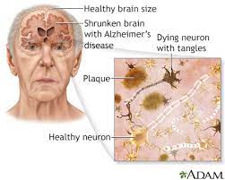 Aging Changes In The Nervous System