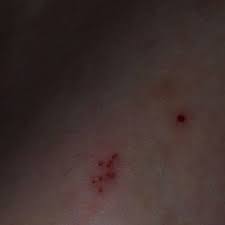 Image result for spinne biss haut reaktion