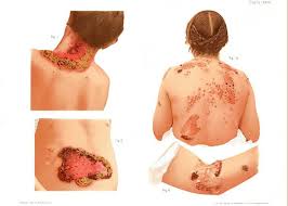 Image result for Secondary Syphilis