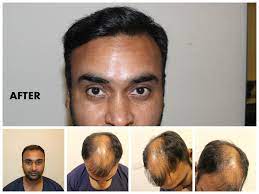 Amit Mishra Hair Transplant Lots Of Celebrities Like Amit Mishra Has Done Successful Hair Transplant Hair Best Hair Transplant Hair Implants Hair Transplant