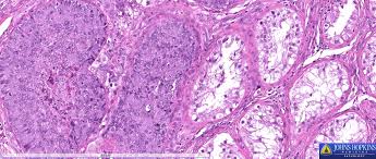 Read more asbestos mesothelioma legal news; Hopkins Pathology On Twitter A 50 Year Old Male Presents With A Testicular Mass Shown Below What Is Your Diagnosis A Yolk Sac Tumor B Seminoma C Mesothelioma D Embryonal Carcinoma E