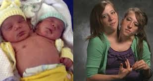 Twins abby brittany hensel turn 16. 30 Interesting Things About Famous Conjoined Twins Abby And Brittany Hensel