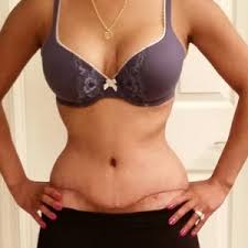 Adding a tattoo to cover a tummy tuck scar. Would You Recommend A Tattoo To Cover My Tummy Tuck Scar Photos