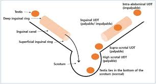 (biology) an analogous gland in invertebrates such as the hydra. Comparison Of Diagnostic And Treatment Guidelines For Undescended Testis