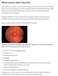 Optic Neuritis And Neuropathy In 2020 Optic Neuritis Medical Pins Optometry Education