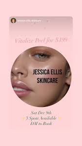 Larissa's Lip Filler treatment with Melanie at Flawless