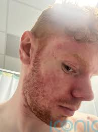 Man, 26, left with 'acid burn' rashes and 30 toilet trips per day after  food poisoning turns out to be incurable disease