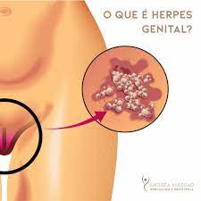 O que é Herpes Genital? 