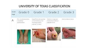 Image result for Wagner Ulcer Classification