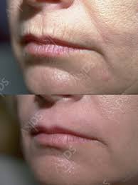 The chemical used for deep chemical peels is phenol acid. Chemical Peels For Wrinkles