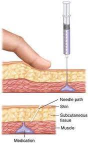Z Track Techniek Inspuiting Injection Collar Definition Of Injection Collar By Subcutaneous Tissue Injections Medical Terms