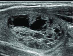 Thyroid Us Showing A Cystic Spongiform Nodule Compatible With A Benign Download Scientific Diagram