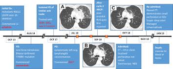 A cough is considered a common sign of a cold or respiratory infection, however, a lingering cough that gets worse instead of better with time and treatment can be a sign of nsclc. Occult Gastrointestinal Perforation In A Patient With Egfr Mutant Non Small Cell Lung Cancer Receiving Combination Chemotherapy With Atezolizumab And Bevacizumab Brief Report Clinical Lung Cancer