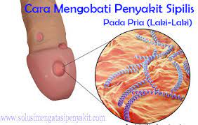 Ciri ciri penyakit kencing nanah serta gejala gejala yang dialami :buang air kecil terasa sakit atau nyeri atau perihkeluarnya cairan seperti nanah pada. Jenis Obat Apotik Untuk Sipilis Terpopuler 3 Hari Sembuh Brug Menceng