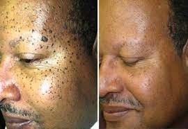 10 Formas Efectivas De Como Eliminar Lunares De Carne Skin Tags Home Remedies Skin Moles Natural Home Remedies