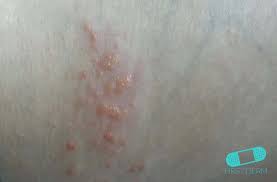 Aşağıda daha fazla bilgi bulabilirsiniz. Herpes Zoster Culebrilla Guia De La Piel