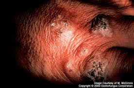 Presentamos el caso de una mujer de 34 años de edad con infección por vih que desarrolló una mucormicosis cutánea primaria necrótica relacionada con el uso de catéter. Esporotricosis Enfermedades Infecciosas Manual Msd Version Para Profesionales