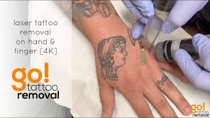 She knows firsthand, the latest, proper procedures in removing tattoo(s). Laser Tattoo Removal On Hand And Finger 4k Youtube